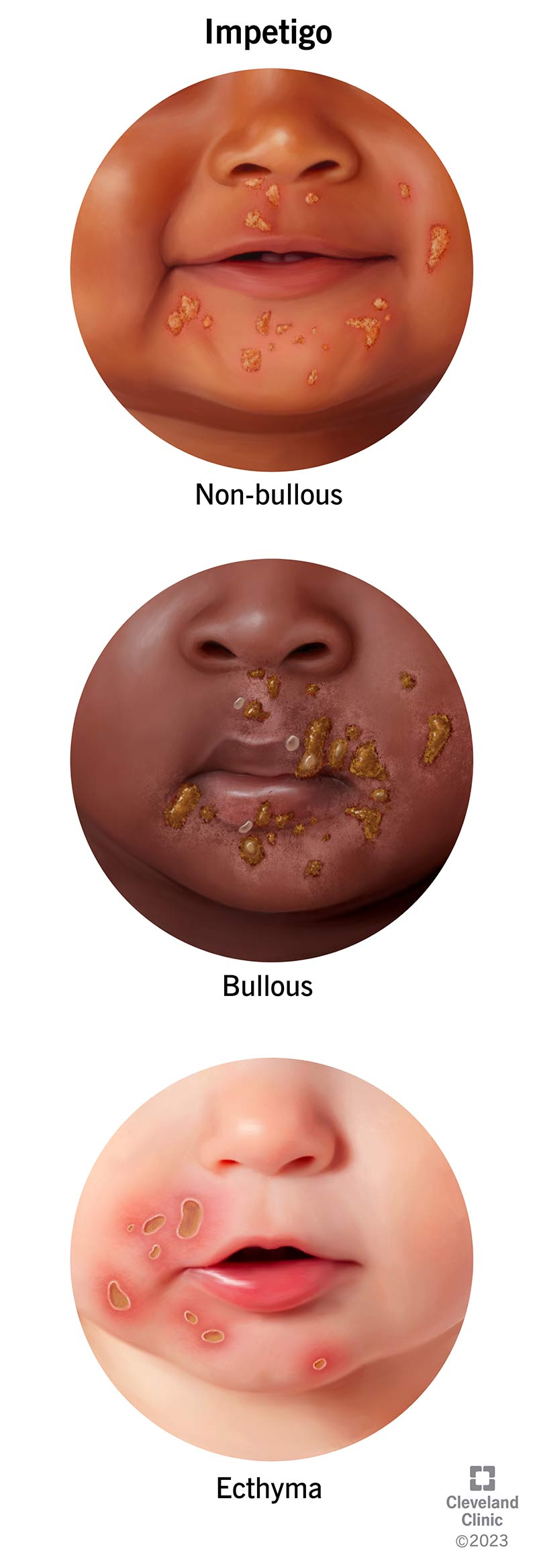 <p>PP: gram-positive bx infxn</p><p>E: s. aureus<br>10% of peds derm<br>warm/humid environment<br>highly contagious<br>face<br>extremities</p><p>spreads:<br>cutaneously<br>systematically (rare)</p><p>CM:<br>bullous:<br>-m/c peds<br>-blisters (enlarge+rupture)</p><p>nonbullous:<br>small+easily ruptured vesicles→<strong>honey-covered crusts</strong></p><p>DX: bx culture</p><p>TX:<br>NP: proper hand washing</p><p>MX: cephalexin<br>cefadroxil<br>topical mupirocin</p>