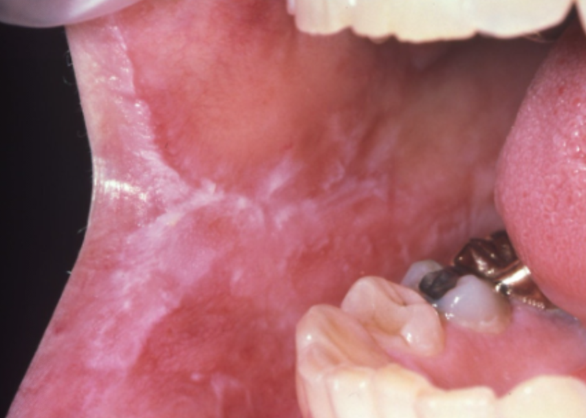 <p>2d. If symptoms persist after removing the allergen, which medication is appropriate?</p><p><span><span>Acyclovir tablets</span></span></p><p><span><span>Nystatin mouth rinse </span></span></p><p><span><span>Fluocinonide gel</span></span></p><p><span><span>Mycelex troches</span></span></p>