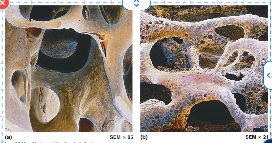 <p>Image B is spongy indicating what?</p>