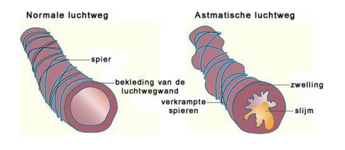 <p>Vernauwing van de luchtwegen door zwelling van de slijmvliezen, verhoogde productie van slijm en samentrekking van de spieren</p><p>Etiologie van prikkeling/ontsteking luchtwegen:</p><ul><li><p>Allergie&nbsp;(huisstofmijt, dieren, pollen)</p></li><li><p>Prikkelende stoffen </p></li><li><p>Luchtweginfecties</p></li><li><p>Koude lucht </p></li><li><p>Lichamelijke inspanning</p></li></ul><p></p>