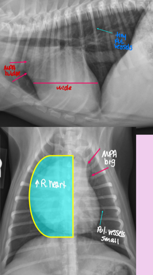 <p>-Right heart enlargement (RVE +/- RAE) d/t <u>PRESSURE</u> OVERLOAD</p><p>-MPA enlargement</p><p>-Normal to small pulmonary vessels (hypoperfusion)</p><p>+/- RHF</p>