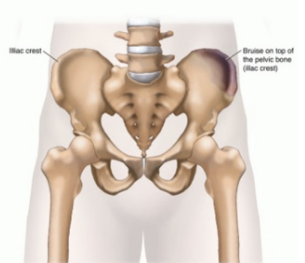 <p>Coccygeal contusion</p>