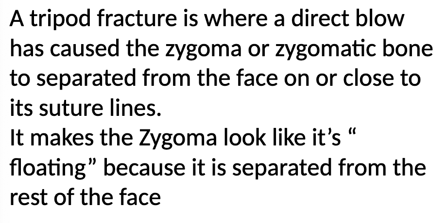 <p>Fracture caused by a direct blow to the zygoma</p>