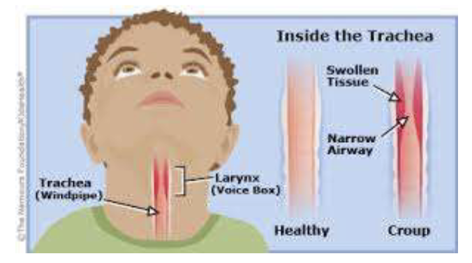 <p>Abnormal Finding! Medical emergency! </p><ul><li><p>audible harsh, high pitched, crowing sounds associated with airway obstruction in or near the larynx </p></li><li><p>can be heard on inspiration and/or expiration </p></li><li><p>May hear with or without a stethoscope</p></li><li><p>Medical emergency </p></li><li><p>Ex: croup, epiglottitis, foreign body aspiration, airway edema from anaphylaxis </p></li></ul><p></p>