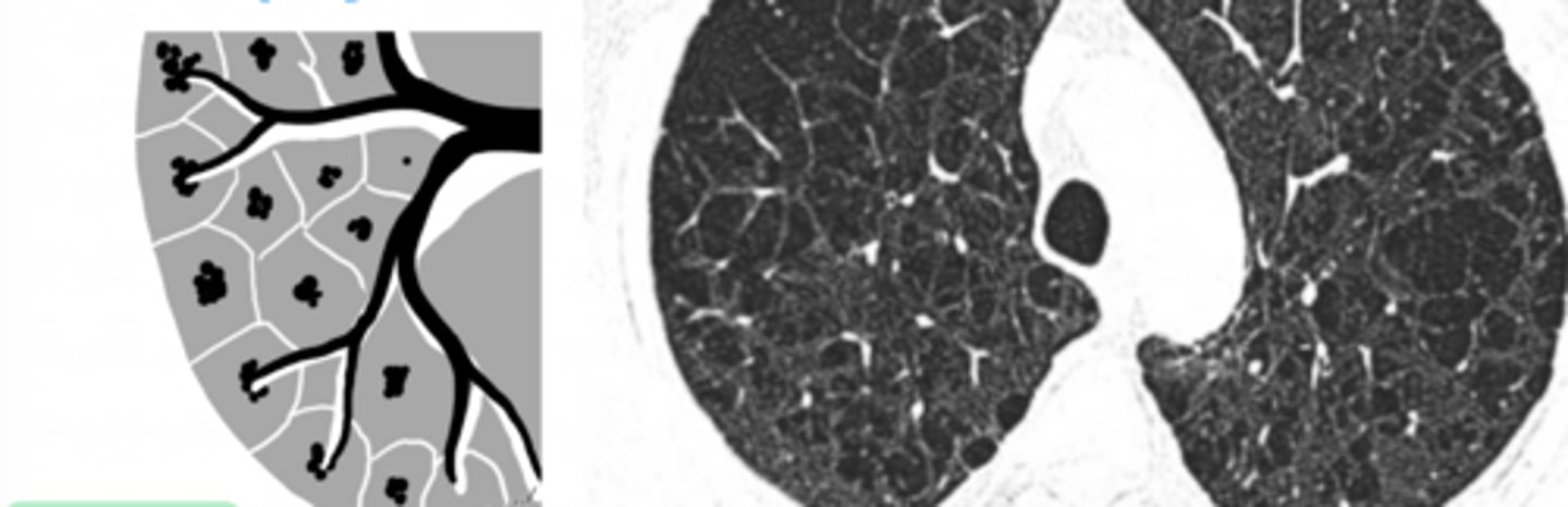 <p>What type of emphysema is this?</p>