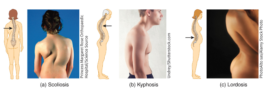 <ul><li><p>herniated disc - may occur due to trauma or aging</p></li><li><p>curve in the spinal column may become exaggerated</p><ul><li><p>scoliosis (increased lateral curvature)</p></li><li><p>kyphosis (increased thoracic curve - bent forward)</p></li><li><p>lordosis (increased lumbar curve - bent backward)</p></li></ul></li></ul>