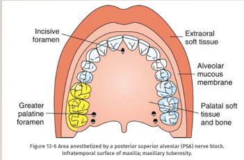 <p>-pulps of the maxillary third, second, and first molars (entire tooth = 72%, MB root of the maxillary first molar not anesthetized = 28%)</p><p>-buccal periodontium and bone overlying these teeth</p><p>-***second injection necessary for treatment of the first molar (MB root) in 28% of pts→infiltration as second injection</p>