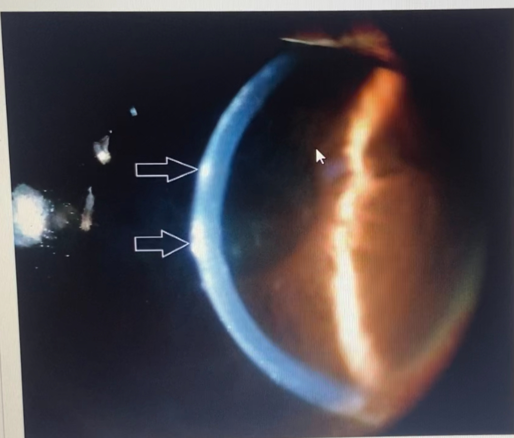 <p>There are lesions in the cornea shown below. What layer of the  cornea is this </p>
