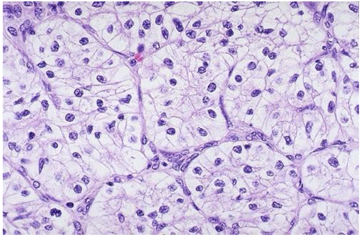 <p>65 yo obese male with hematuria and a flank mass. What is the diagnosis of this renal cancer?</p>