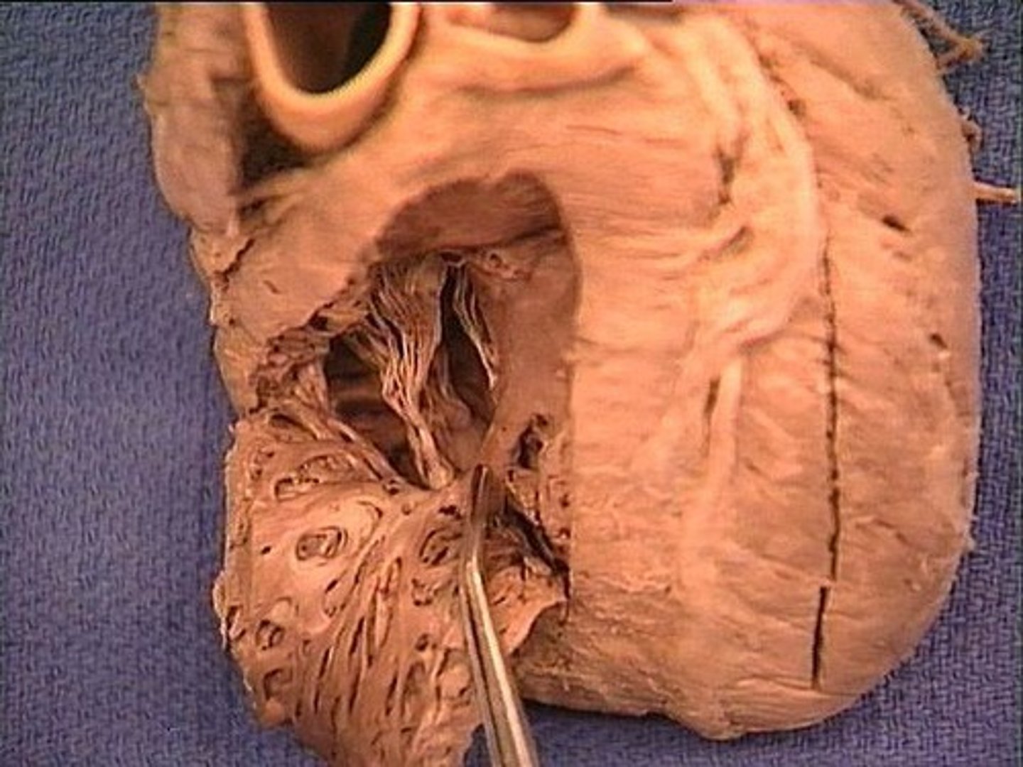 <p>found in right ventricle, carries impulse to right ventricular wall</p>