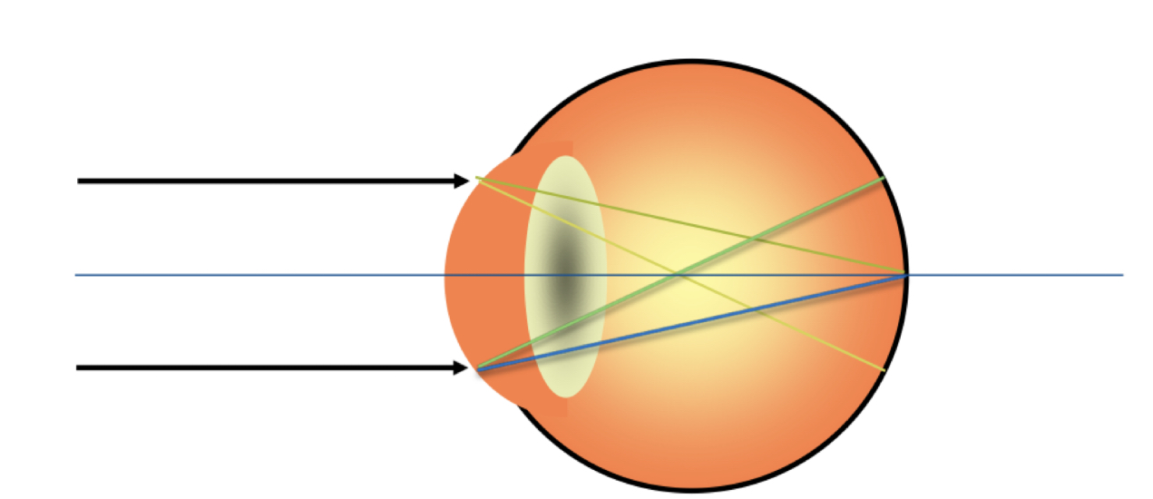 What type of astigmatism is this?