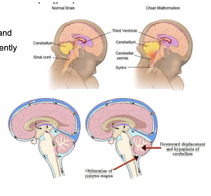 <ul><li><p>4 syndromes — Type 1 (out of 4) is most common</p></li><li><p>Herniation of cerebellar tonsils, caudal vermis, and medulla through the foramen magnum — frequently associated with syringomyelia</p></li><li><p>Posterior cranial fossa problems</p></li><li><p>Example of (could lead to) non-communicating hydrocephalus</p><ul><li><p>Obstructed CSF flow within the ventricular system&nbsp;</p></li><li><p>Communication at 4th ventricle is compressed</p></li></ul></li></ul>
