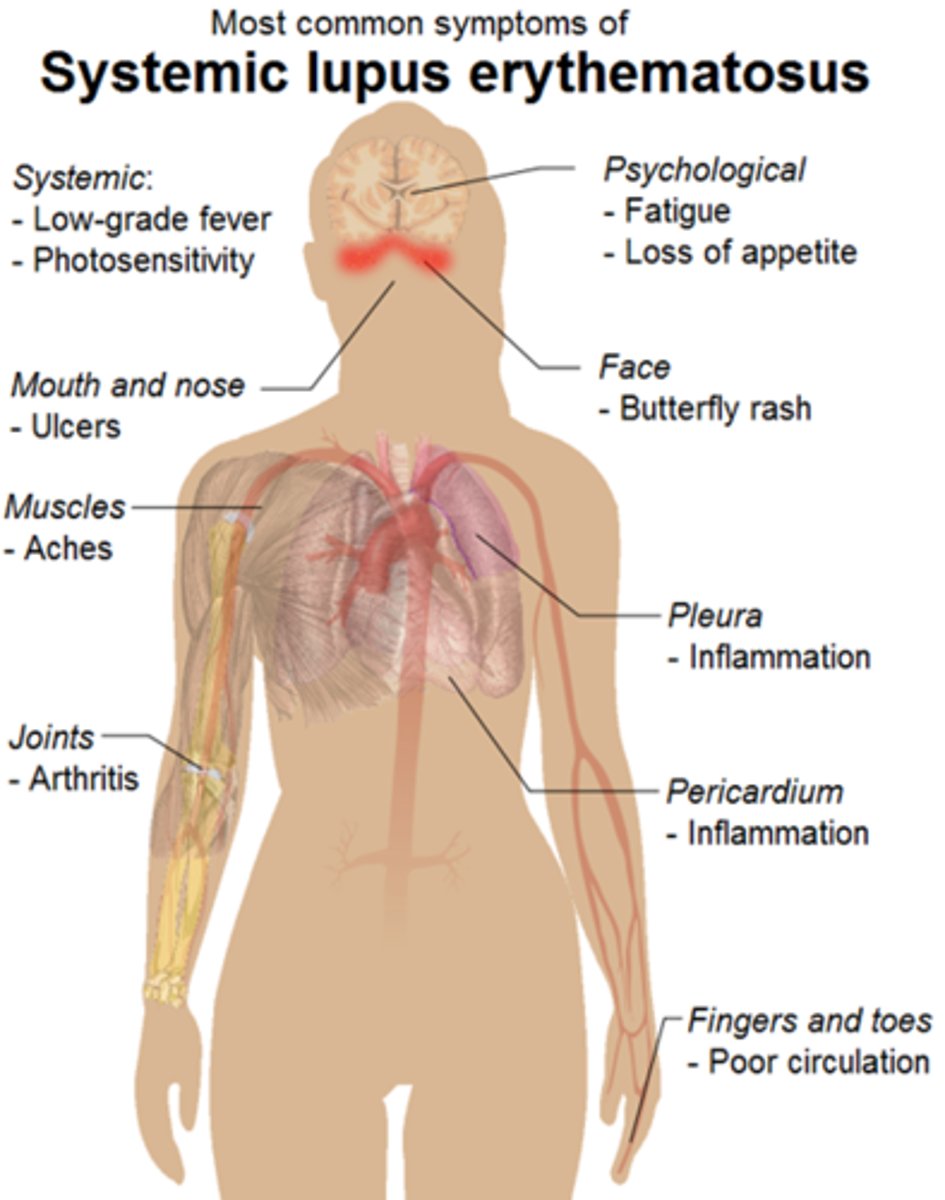 <p>1. Butterfly rash<br>2. Mouth ulcers <br>3. Raynaud's phenomenon/'cold pale fingers'<br>4. Fatigue <br>5. Depression <br>6. Weight loss</p>