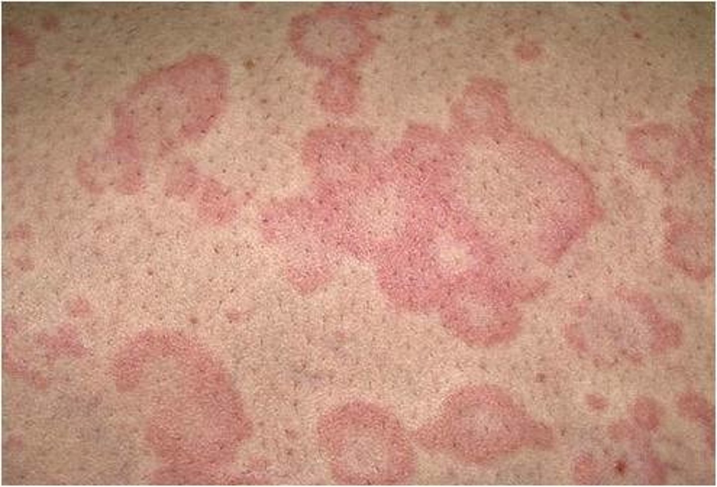 <p>IgE mediated allergic reaction that appears as itchy wheals with central blanching</p><p>- may be a precursor to anaphylaxis</p>