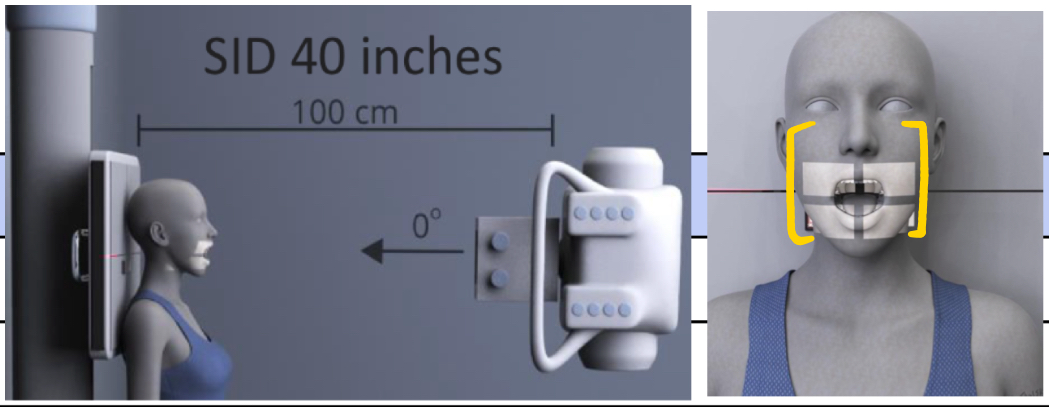 <p>SID: 40”</p><p>Air Gap: NO</p><p>Cassette Size: 10×12</p><p>Collimation: excludes eyes and thyroid cartilage (light box just beneath orbital fissure, just above/around chin)</p><p>Tube tilt: N/A</p><p>Measure through: mid-neck</p><p>Central ray: centre of mouth</p><p style="text-align: left">Breathing: suspend RESPIRATION </p>