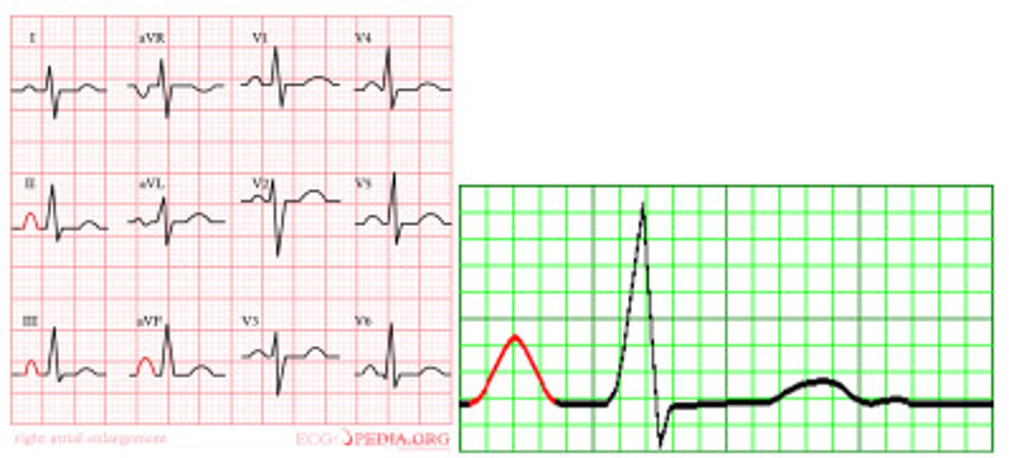 <p>tall P waves! (in lead II, III, and aVF)</p><p>- &gt; 2.5 boxes</p><p>cause: pulm HTN, COPD, Pulm emboli</p>