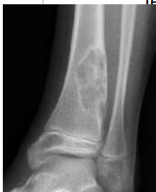 <p>What do we see in the contour of this lesion?</p>