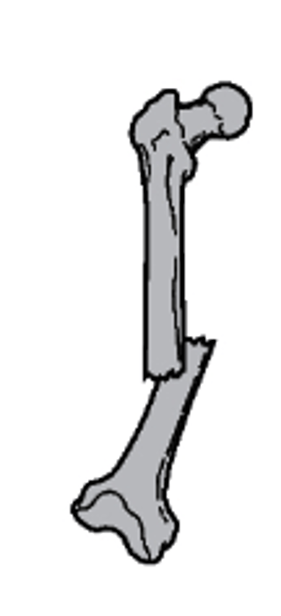 <p>what type of fracture is this</p><p>a. overriding with posterior and superior displacement</p><p>b. distracted</p><p>c. lateral displacement</p><p>d. distracted and rotated laterally</p>