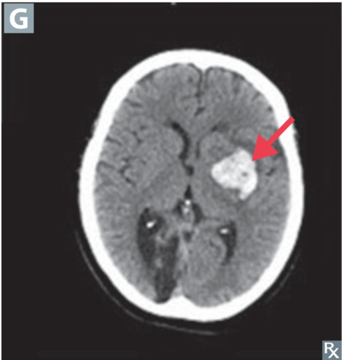 <p>Define Traumatic Vascular Injury:</p><p>Bleeding within the brain tissue</p><p>-Often occurs in premature infants, bleeding within germinal matrix - near lateral ventricles</p><p>-Risk of extension into ventricular system</p>