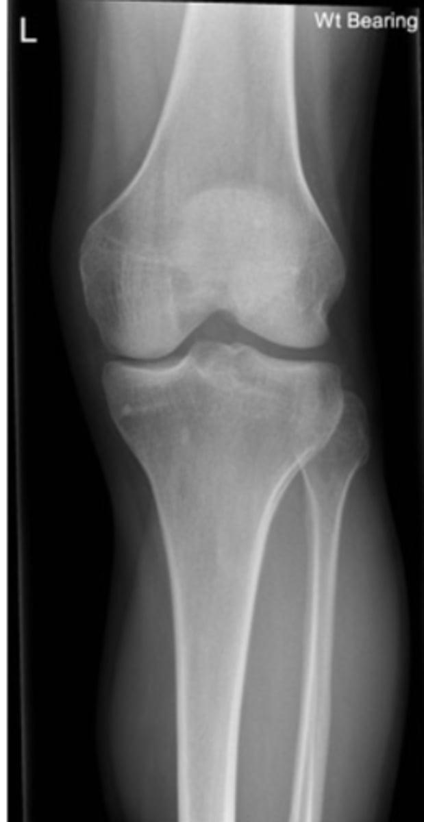 <p>- distal femur<br>- proximal tibia and fibula<br>- no patella or tibial plateau</p>