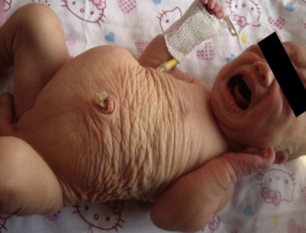 <p>A group of birth defects that results in poor development of the abd muscles, enlargement of the ureters and bladder, bilateral UDT and VUR</p>