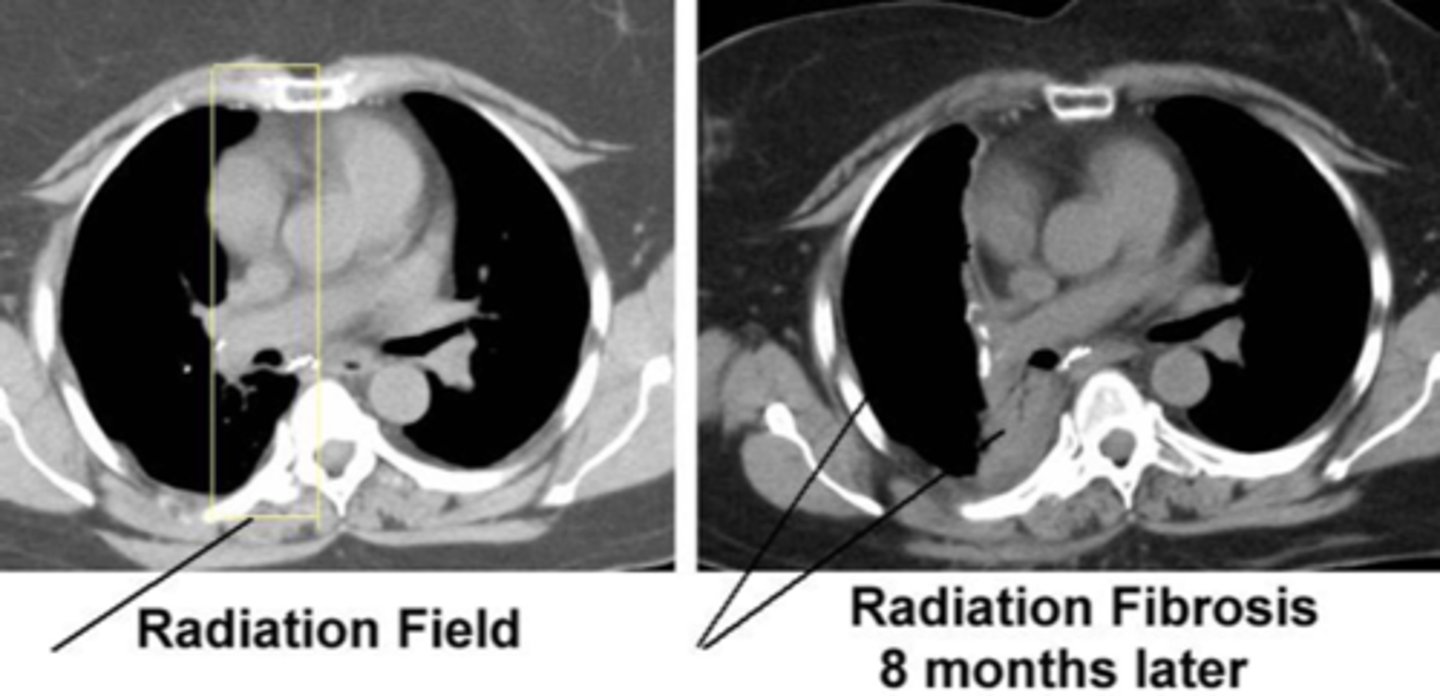 <p>tight tissue, axillary webbing, altered sensation, OP, mucositis, diarrhea, frequency, urgency, urinary stenosis, fertility issues</p>