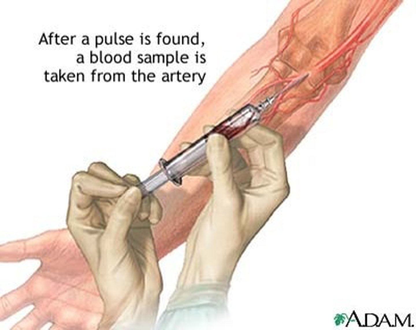 <p>a diagnostic test examining arterial blood; used to determine the pressure exerted by oxygen and carbon dioxide in the blood</p>