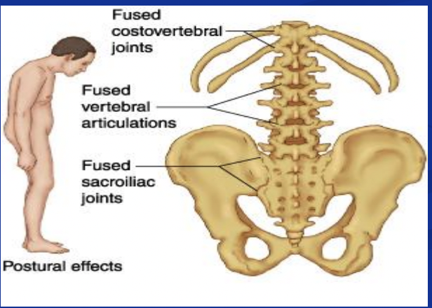 <ul><li><p>ankylosing spondylitis (90%)</p></li><li><p>reactive arthritis/formerly reiters syndrome (75%) </p></li><li><p>psoriatric arthritis/arthritis of ulcerative colitis or Crohn’s </p></li></ul><p></p>
