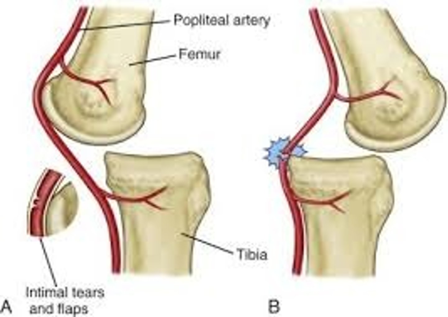 <p>A: Fixed position between femur and tibia; prone to damage in knee dislocation</p>