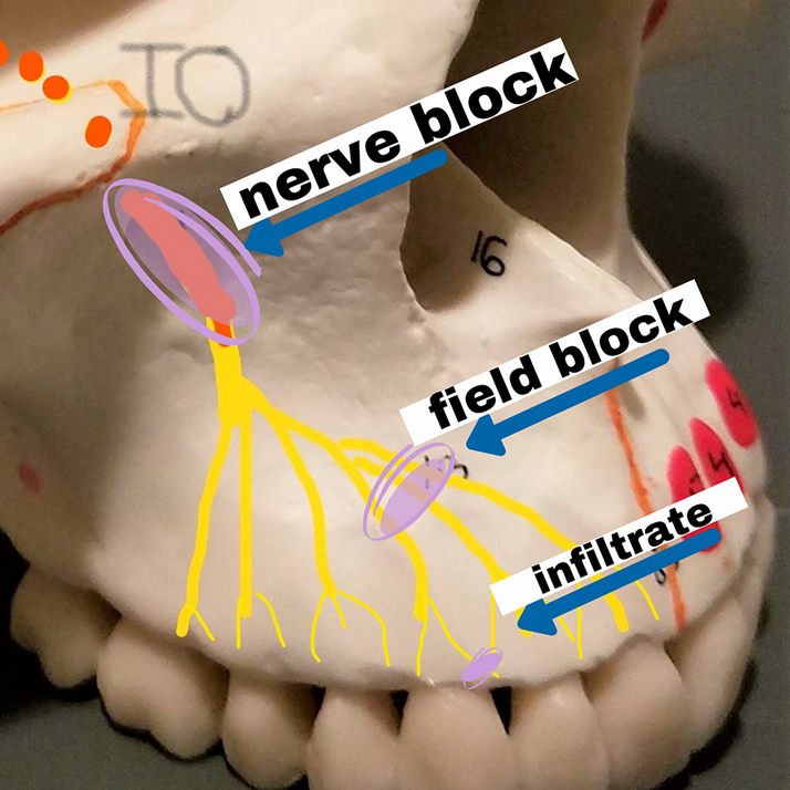 <p>what routes do we use for local anesthesia</p>