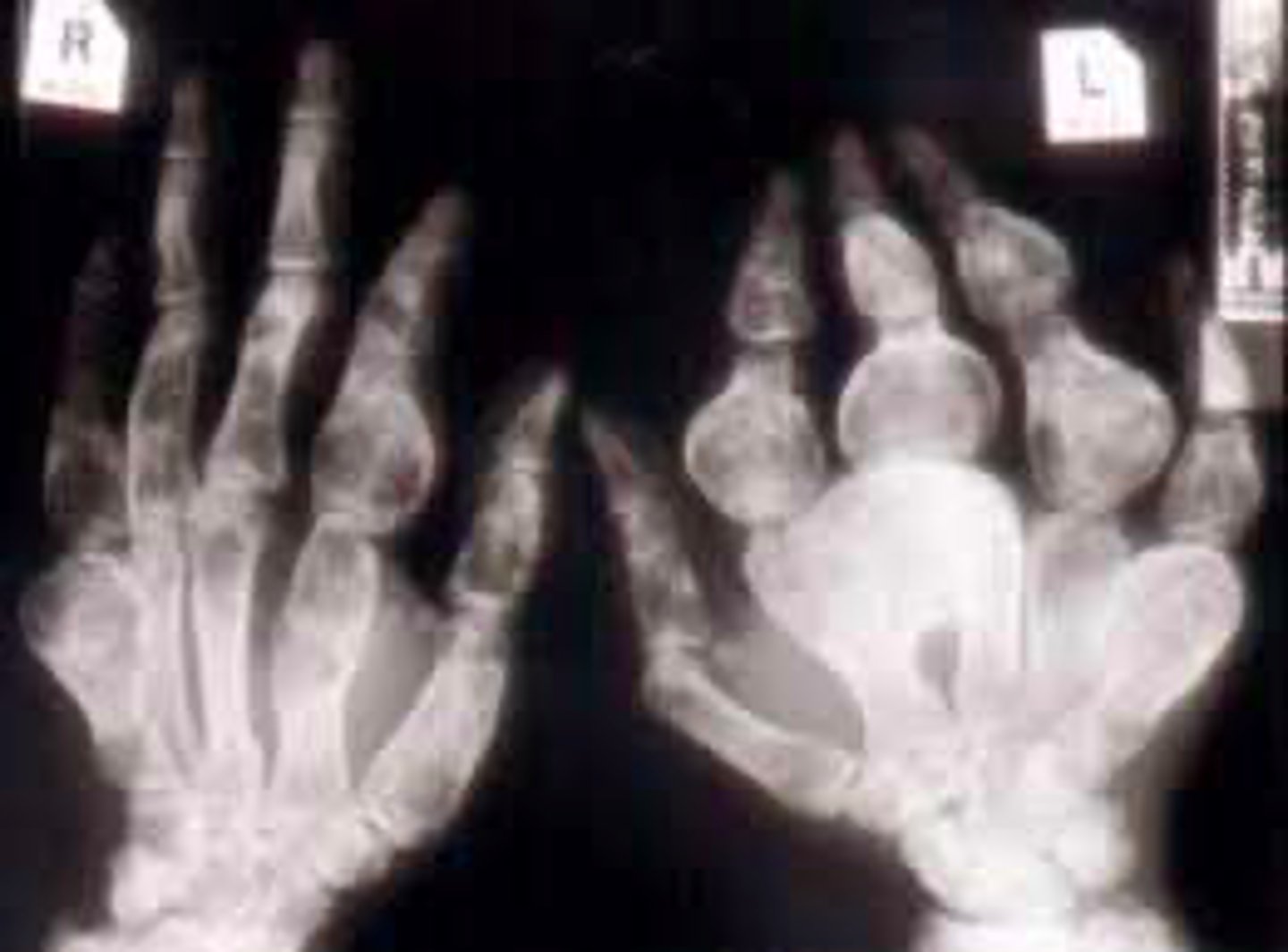 <p>Vignette # 10</p><p>Sex: Male</p><p>Age: 24</p><p>Chief Complaint: Mechanic presents with loss of grip strength. The patient reported having swollen fingers that previous hurt but the pain went away.</p><p>Objective Findings: ROM in his hands are decreased, notable swelling of the tissue in his fingers</p><p>Diagnostic imaging: X-ray</p><p>2. What else could be associated with this condition? (Choose 3)</p><p>a. CREST sign</p><p>b. Sessile appearance</p><p>c. Geographic lesion</p><p>d. Blister of bone appearance</p><p>e. Periostitis (inflammation of layer of CT that surrounds bone)</p><p>f. Cortical thinning</p><p>g. Subchondral cysts</p><p>h. Expansile lesion</p>