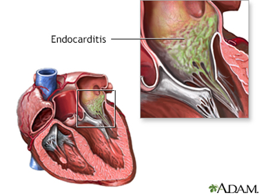 <ul><li><p class=""><strong>At-Risk Patients:</strong></p><ul><li><p class="">Those with CHD, prosthetic valves, and central lines.</p></li></ul></li><li><p class=""><strong>Definition:</strong></p><ul><li><p class="">A microbial infection of the endothelial surfaces of the heart’s chambers, septum, or most commonly, the valves</p></li></ul></li><li><p class=""><strong>Causes:</strong></p><ul><li><p class="">Bacteria or fungi gain access to the endothelium</p></li><li><p class="">Infection can spread to other parts of the body</p></li></ul></li><li><p class=""><strong>Symptoms:</strong></p><ul><li><p class="">Vague flu-like symptoms (low-grade fever, pale, etc.)</p></li><li><p class="">Fatigue</p></li><li><p class="">Anorexia or weight loss</p></li></ul></li><li><p class=""><strong>Monitor</strong>:</p><ul><li><p class="">Full Cardiac—ECG leads, HR, RR, Pulse ox, &amp; BP.</p></li></ul></li><li><p class=""><strong>Treatment:</strong></p><ul><li><p class=""><strong>IV Antibiotics or antifungals</strong> for approximately <strong><u>4 to 6 weeks</u></strong>.</p></li></ul></li></ul><p></p>