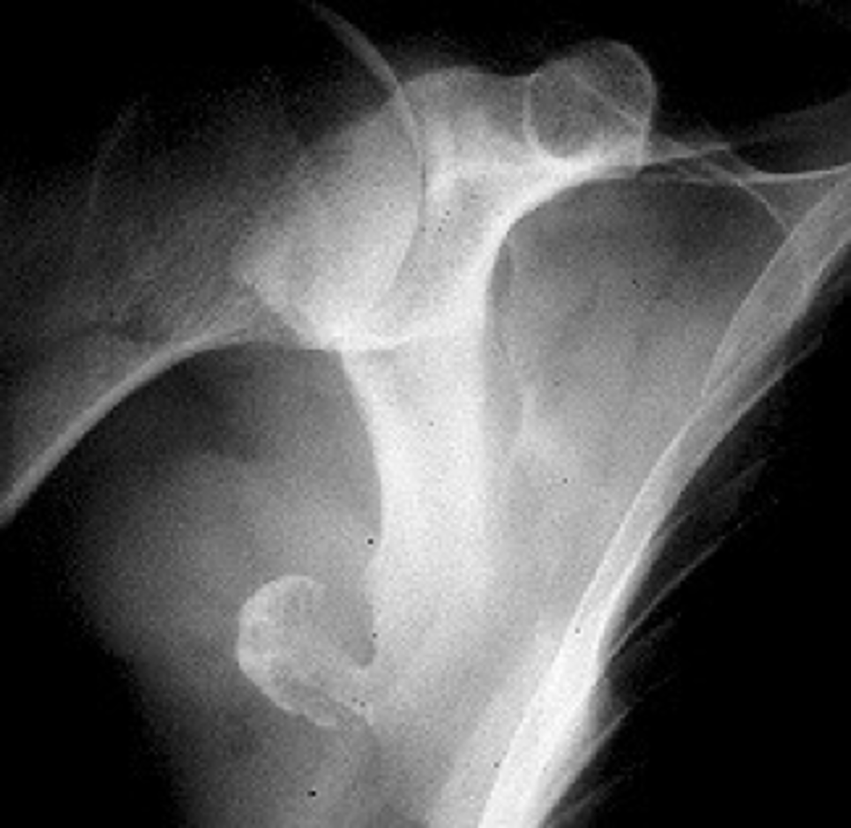 <p>_____ solitary osteochondroma:</p><p>- Metaphyseal</p><p>- Thin, elongated stalk</p><p>- Cortex and medulla continuous</p><p>- Calcified cap</p><p>- Projects away from joint</p><p>- Lucent when en face (on end)</p>