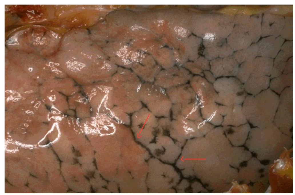 <ol><li><p>What are these black streaks seen in between lobules of the lung pleural surface?</p></li><li><p>Who are people that show more of these pigments in their lungs?</p></li></ol><p></p>