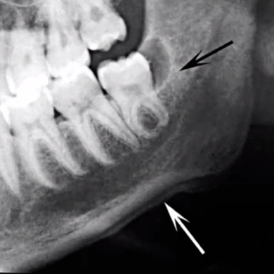 <p>inflammation around the crown</p><ul><li><p>commonly seen with wisdom teeth</p></li><li><p>diagnosis made clinically, but can see radiographic evidence similar to periodontitis</p></li><li><p>dense, reactive bone formation may present around follicle</p></li></ul><p></p>
