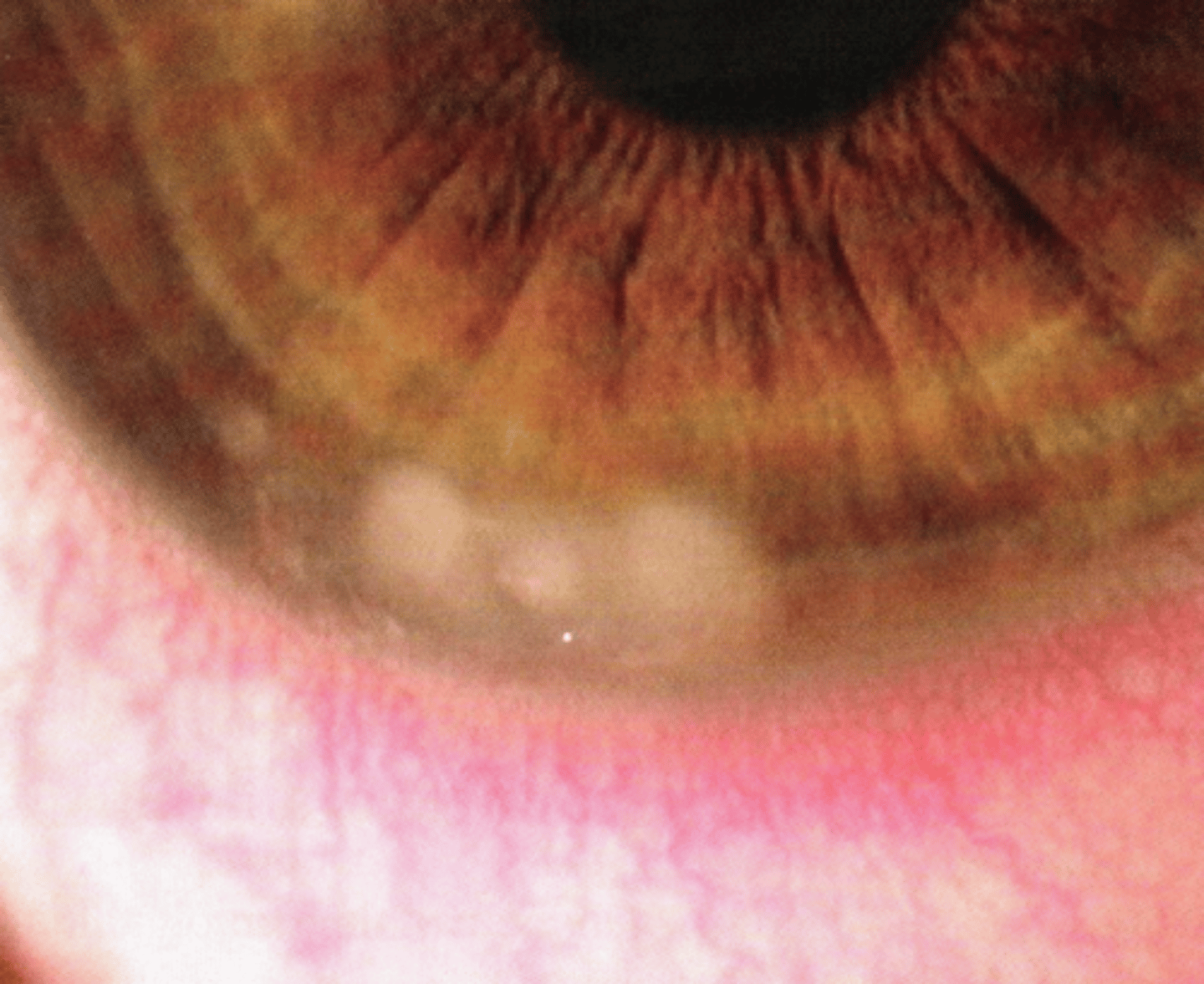 <p>Should we culture this lesion shown here? *staining less than infiltrate size</p>