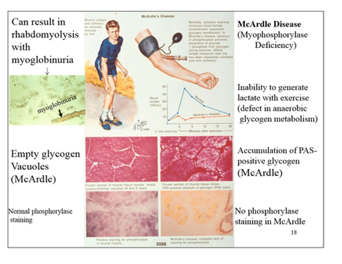 <p>AR McArdle disease</p><p>(skeletal muscle glycogen phosphorylase deficiency)</p><p>-defect in anaerobic glycogen metabolism</p>