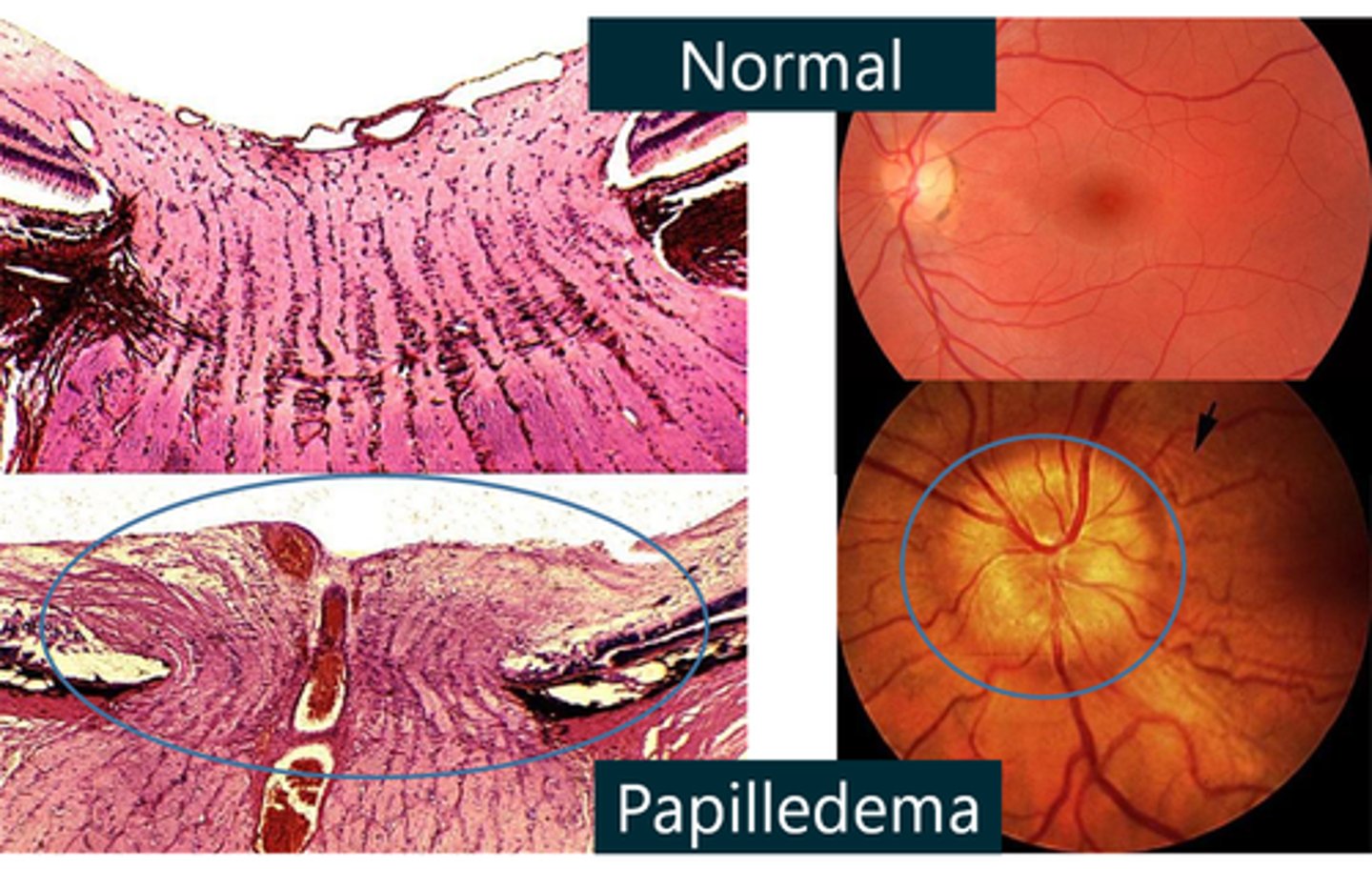 <p>It is diagnosed through a fundoscopic exam, which shows a swollen and enlarged optic disc, and imaging such as MRI with contrast and lumbar puncture (if appropriate).</p>