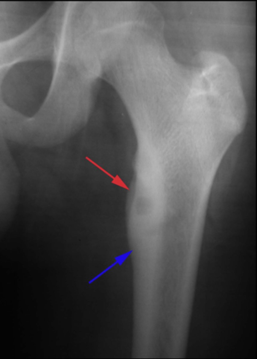 <p>The severe pain caused by osteoid osteoma is relieved by _____</p>