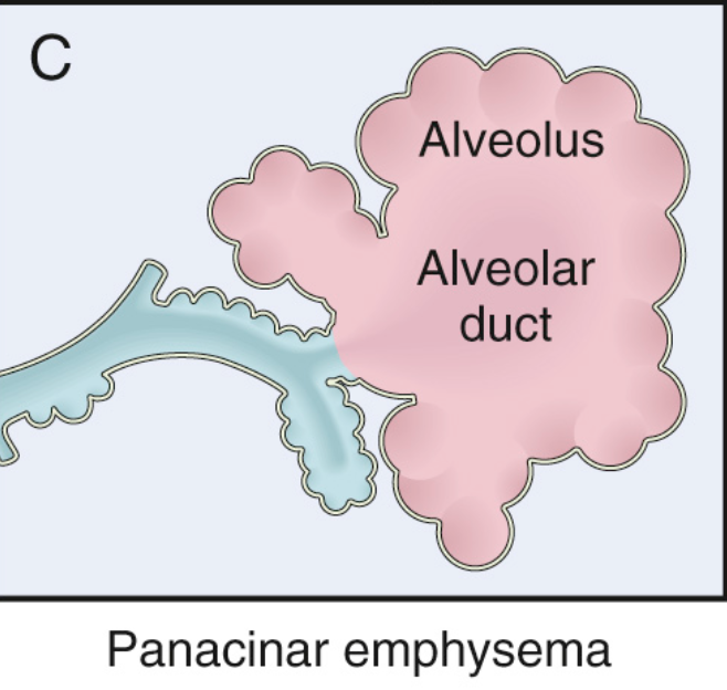 <p>¿A qué se asocia el enfisema panacinar y en qué zona del pulmón tiende a ocurrir?</p>