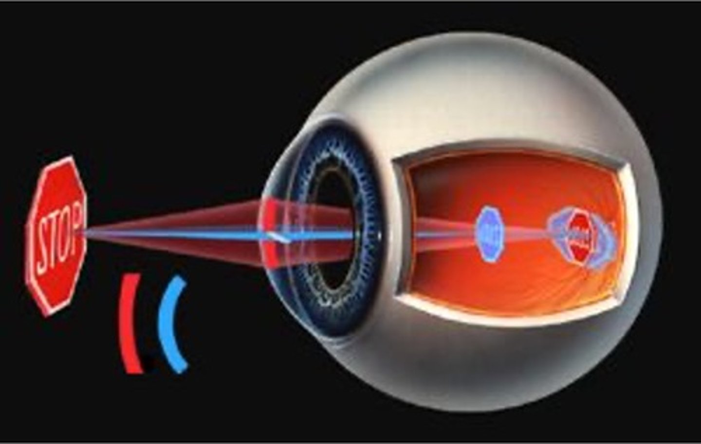 <p>change in normal shape of cornea; can also occur with the lens. leads to a fuzzy image to the retina</p>