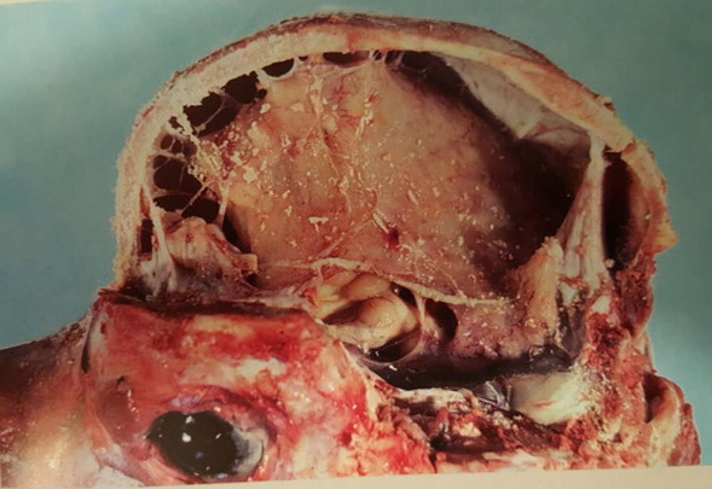 <p>Hjerne fra okse. Patoanatomisk diagnose? Hvad kan ætiologi være?</p>