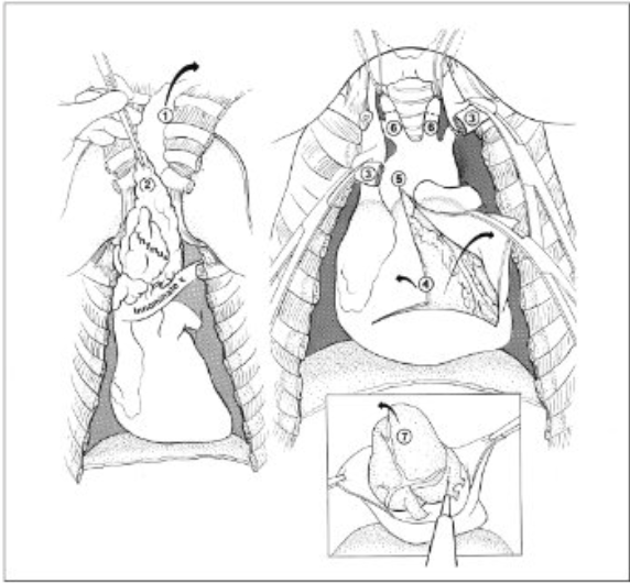 <ol><li><p>Reflect chest plate and strap muscles to expose the lower neck.</p></li><li><p>Blunt dissect thymic fat pad from the pericardium. Carry reflection upward to lower pole of thyroid. Cut the thymic vein where it enters the innominate vein.</p></li><li><p>Double-clamp, divide, and reflect the innominate vein.</p></li><li><p>Open pericardium and clamp edges. inspect pericardial surfaces and contents.</p></li><li><p>Extend the pericardial incision through the pericardial reflection.</p></li><li><p>Isolate and ligate the carotid arteries</p></li><li><p>Lift the heart cranially and draw blood samples from the left atrium.</p></li></ol>