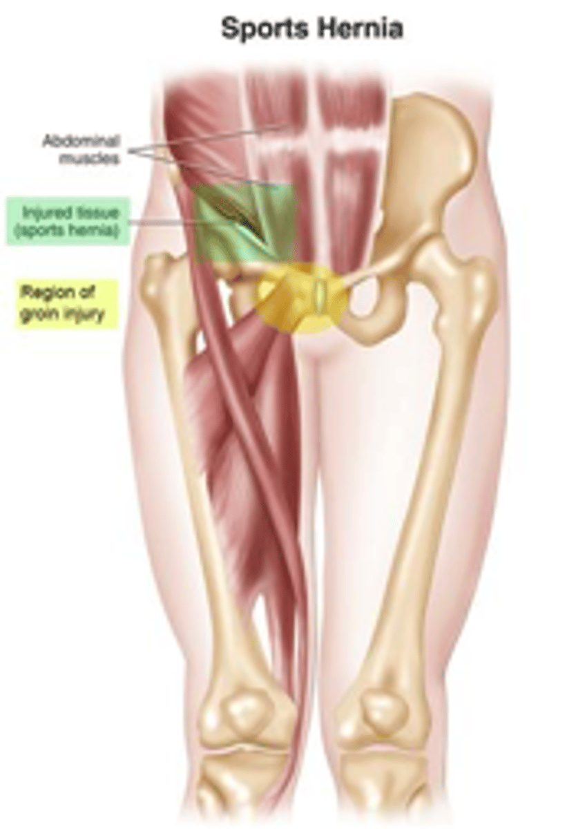 <p>hip adductor or rectus obdominus avulsion (torn) from pubic rami</p>