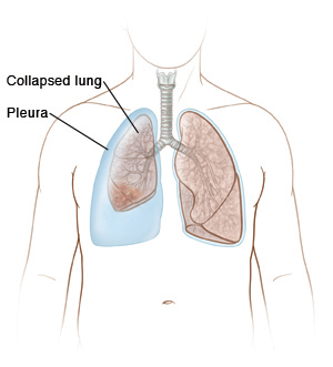 incomplete expansion or collapse of part or all of a lung due to mucus, tumor, trauma, or a foreign body that blocks the bronchus
