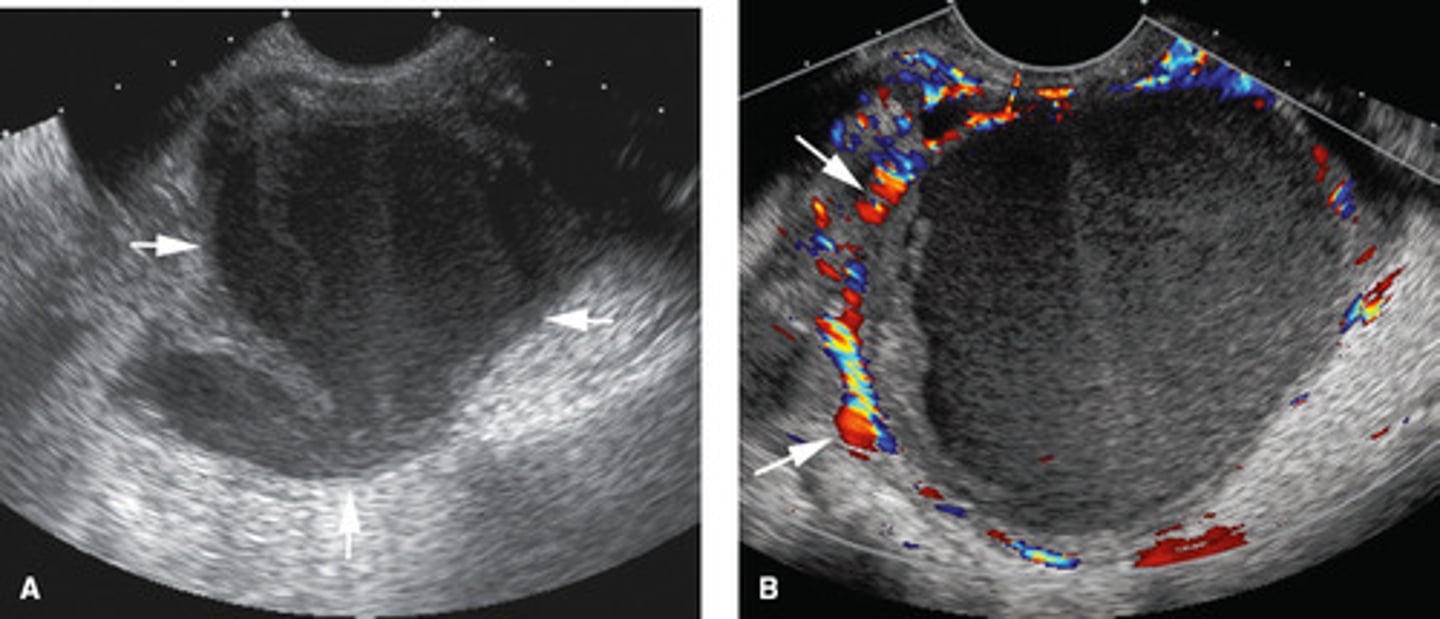 <p>tubo-ovarian abscess</p>