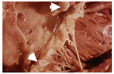 <p>vegetation on heart valve</p><p>drug choice depends on:</p><ul><li><p>causative pathogen</p></li><li><p>presence of prostheses</p></li><li><p>drug allergy history</p></li><li><p>renal function</p></li><li><p>risk of MDR organism</p></li><li><p>social history i.e. IV drug use</p></li></ul><p>combination of antibiotics usually required for 4-6 weeks</p><p>usually IV amoxicillin + gentamicin for IE caused by alpha-hemolytic streptococci</p>