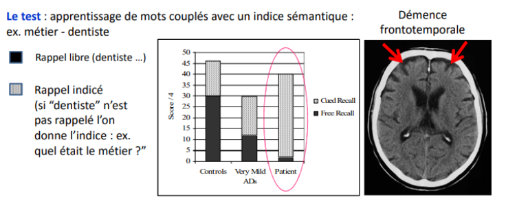 <p>caractérisée par une amnésie par déficit au rappel, avec un encodage relativement préservé (car l’hippocampe n’est pas touchée) = inverse du circuit de Papez. Ici, l’information est encodée mais le patient n’a pas la capacité stratégique de recherche.</p><p>test : apprentissage de mot couplés avec un indice sémnatique ex : dentiste - métier</p><p>Le rappel libre implique une recherche active en mémoire en utilisant des indices (diminution dans les lésions fronto-souscorticales) → Le fait de fournir des indices améliore substantiellement le rappel !</p><p>au milieu : n’atteindra jamais la norme car </p><p>la 3e à D : démence frontotemporale : le patient atteint presque la norme </p>