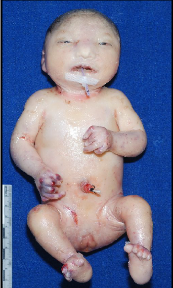 <p>severe growth delays; distinctive facial and head abnormalities</p>