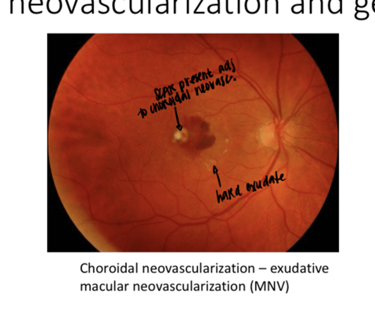 <p>Choroidal Neovascularization -- WET AMD -- Exudative Macular Neovascularization (Pic)</p>